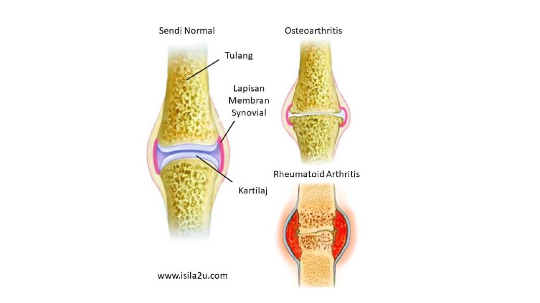 osteoarthritis