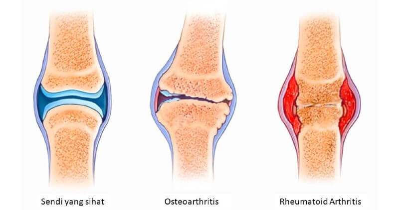 osteoarthritis vs rheumatoid arthritis