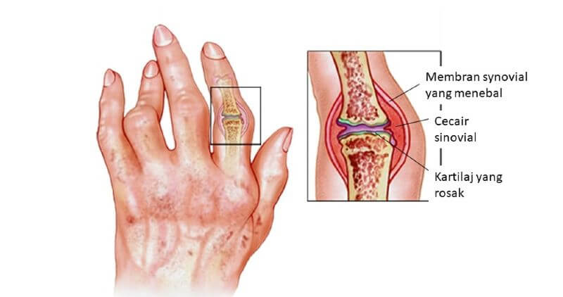 rheumatoid arthritis