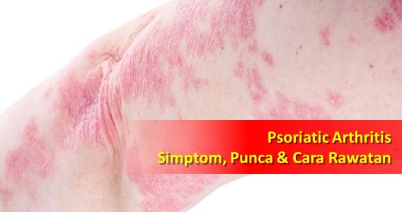 psoriatic arthritis